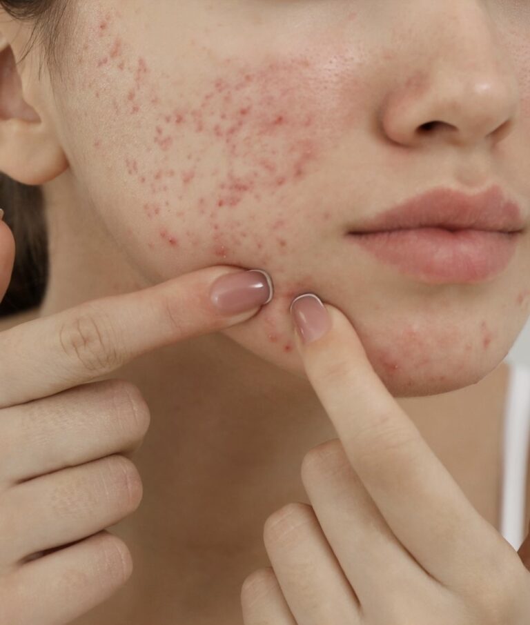 Clear Skin Ahead: How to Beat Facial Pimples for Good